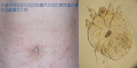 感染「疥蟲」讓你半夜癢不停　皮膚科醫師揭4方法預防蟲蟲危機