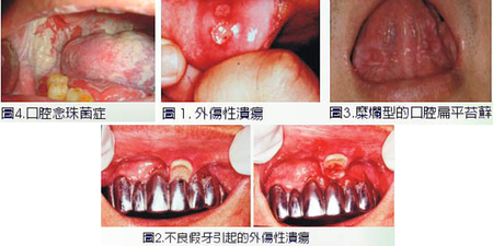 「嘴破一直沒好，是不是得了口腔癌？」　醫師分析四種疾病更有可能