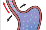 是哪些食物害你「胃食道逆流」停不了？再不看懂這張圖，當心胃破洞越破越大
