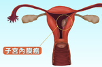 經期不規則又常出血？當心隱性殺手「子宮內膜癌」上身！營養師勸避開4種「殘害子宮食物」