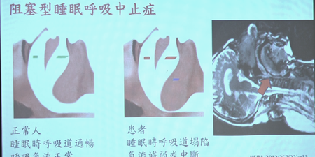 一握方向盤就想睡？「睡眠呼吸中止症」摔車風險多3倍！還是猝死、中風高危險群