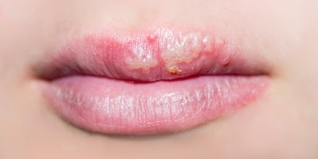【余昊璋醫師】唇皰疹又來 該如何預防復發？