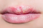 【余昊璋醫師】唇皰疹又來 該如何預防復發？