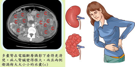 多囊腎是什麼？腎臟病會遺傳嗎？醫師警告：出現兩種症狀就要小心