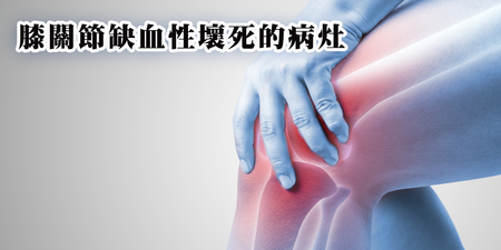 50歲以上女性要小心！容易發生「膝關節缺血性壞死」的原因有兩個