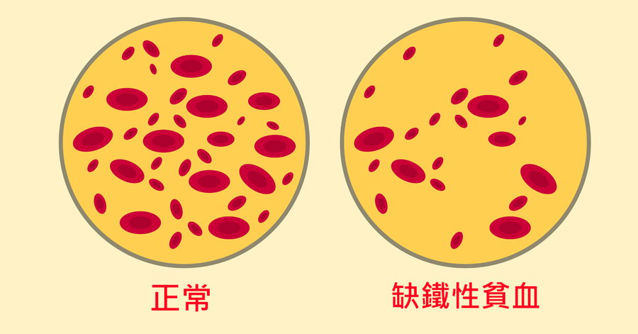 貧血缺鐵卻讓血糖值飆升 何一成醫師提醒 出現三症狀就該當心 每日健康health