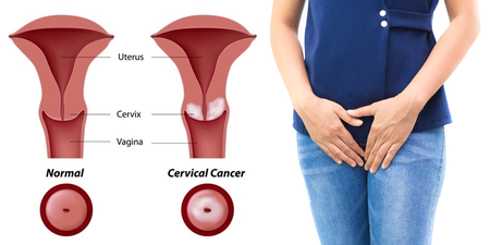 婦女罹患率最高的癌症！醫師點名這5種人感染「子宮頸癌」機率多六倍