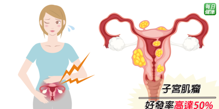 子宮肌瘤罹患率高達50%　陳鴻昇醫師：出現三招症狀需速切除