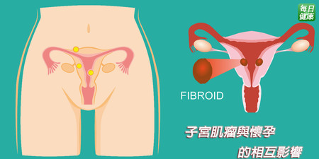 子宮肌瘤會造成難產、不孕嗎？婦科醫師：出現3種情況才有可能