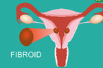 子宮肌瘤會造成難產、不孕嗎？婦科醫師：出現3種情況才有可能