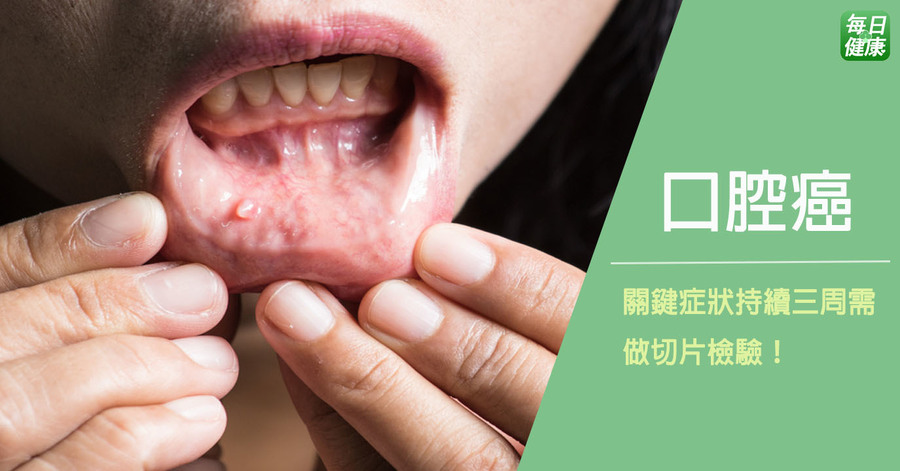 嘴巴破是癌症前兆 三週以上風險增 每日健康health