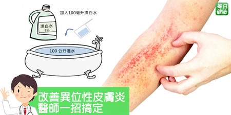 異位性皮膚炎可以根治？使用「漂白水浴」3個月抗菌止癢超有感