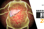 脂肪肝恐致肝癌！　如何逆轉醫師說做2件事最有效