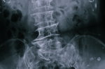 男性罹患「僵直性脊椎炎」機率多四倍　出現臨床4症狀急送醫