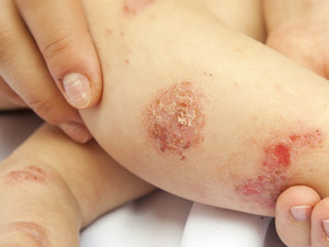 老是皮在癢？日常保養「異位性皮膚炎」的兩大關鍵
