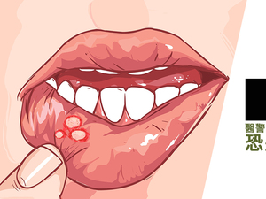 常嘴破是因缺葉酸？醫警告：出現這症狀不注意，恐是口腔癌2期