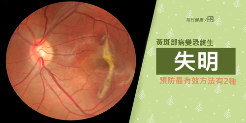 9成高度近視性黃斑部病變會終生失明　預防最有效方法有2種