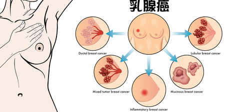 每年約有130萬人罹患『 乳腺癌 』—只要學學日本人做「 9 件事搭配飲食」乳腺癌不敢靠近你。