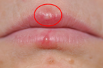 「唇皰疹」讓你又痛又癢？「7個天然療法」減輕發炎、加速皰疹脫落，還你健康雙唇！