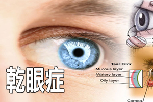 眼睛時常乾澀視線模糊？乾眼症一但發作無法根治，出現這七大症狀千萬注意！