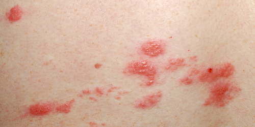 不明原因全身疲憊、皮膚又癢又痛正是「帶狀疱疹」惹的禍！免疫力差、50歲以上屬高危險群，一分鐘看懂發病前因後果！