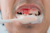 每次刷牙牙齦就狂噴血，牙科醫師：「六大壞習慣」快改吧