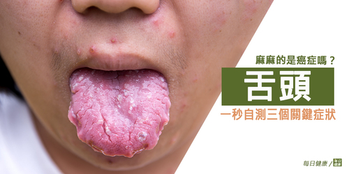 舌頭麻麻的是癌症嗎？一秒自測三個關鍵症狀