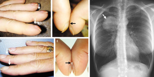 從手指「指甲」就能看出「肺癌」！5大徵兆及早發現提升治癒率