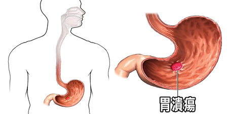 「胃藥」亂吃竟產生幻覺！胃潰瘍真相大公開，別再誤會你的「胃酸」了！