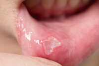 嘴破超過2週等6大症狀速就醫　當心恐是口腔癌找上門！