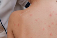 小時候長過水痘，長大就不會復發？醫：錯！這些行為風險超高，包括熬夜！