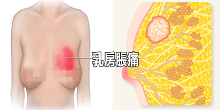 「乳房脹痛」就是肝鬱氣滯！3大「護胸營養素」這樣吃，疏通氣血、調節激素自己來！