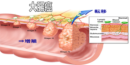 「大腸癌」初期無明顯徵兆，哈佛醫師揭開5組抗癌密碼：這樣做，大腸癌沒你的事！