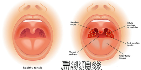 「扁桃腺炎」連吞口水都痛得要命？自製「五種天然飲料」快速緩解發炎，疼痛不再來！