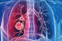 肺癌只能單用標靶或免疫？組合治療分進合擊　老翁7公分腫瘤消失