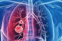 40歲肺癌風險激升！沒抽菸也會得，哪些人應定期檢查？