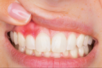 牙齦出血是牙周病？口腔癌？醫指常見６原因，相關症狀盡早檢查！