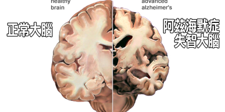 每3人就有1人面臨「失智」危機：掌握五大「護腦飲食」法則，讓「阿茲海默症」變成拒絕往來戶！
