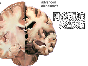 每3人就有1人面臨「失智」危機：掌握五大「護腦飲食」法則，讓「阿茲海默症」變成拒絕往來戶！