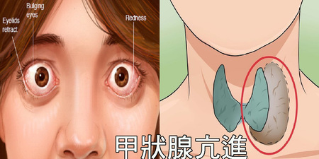 眼凸、怕熱、緊張失眠？當心「甲狀腺亢進」已鎖定你！遵循「四吃四不吃」讓甲狀腺重回平衡。