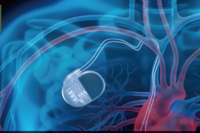 心跳過慢有猝死風險？心臟節律器怎麼選？醫籲出現症狀及早就醫！