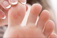 手指、腳趾黑點是病毒疣作祟？醫指常見症狀，盡早檢查慎防皮膚癌！