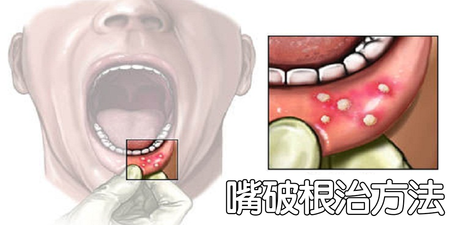 「嘴巴破」喝降火茶無效！秒懂「降肝火」的根治之法，從此「口瘡」與你絕緣！