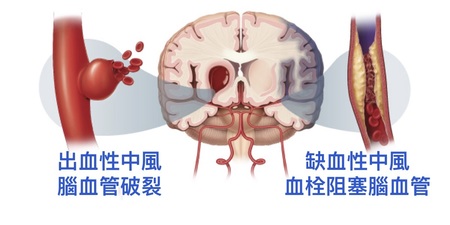 常加班嗎？研究顯示：「工時過長」可能導致「中風」！做對「六」件事，遠離中風威脅！