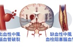 常加班嗎？研究顯示：「工時過長」可能導致「中風」！做對「六」件事，遠離中風威脅！