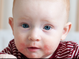 兒童異位性皮膚炎影響大！不僅皮膚、長期恐傷身又傷心