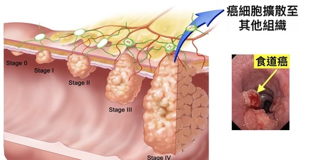 常打嗝？胸痛？喉嚨沙啞？小心「食道癌」！九大常被忽視的「食道癌症狀」，不可不知！