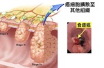 常打嗝？胸痛？喉嚨沙啞？小心「食道癌」！九大常被忽視的「食道癌症狀」，不可不知！