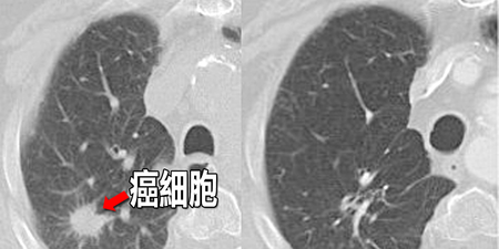 罹癌率降低73%！神經外科博士教你吃對「五大關鍵營養」，讓癌細胞「自動凋亡」！