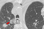 罹癌率降低73%！神經外科博士教你吃對「五大關鍵營養」，讓癌細胞「自動凋亡」！